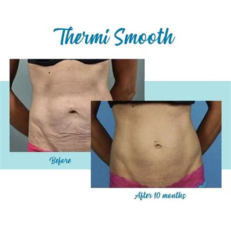 thermismooth alpharetta|Body Contouring Lab » Bella Medspa » Alpharetta & Buckhead.